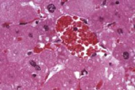<p>What nuclear change is seen in this necrotic image?</p>