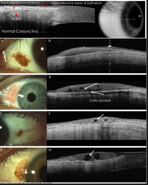 <ol><li><p>OCT - Anterior Segment</p><ol><li><p>melanocytic nevus —&gt; thickened epithelium (hyporeflective band)</p></li><li><p><strong><u>often have cysts!!</u></strong></p></li></ol></li></ol><p></p>
