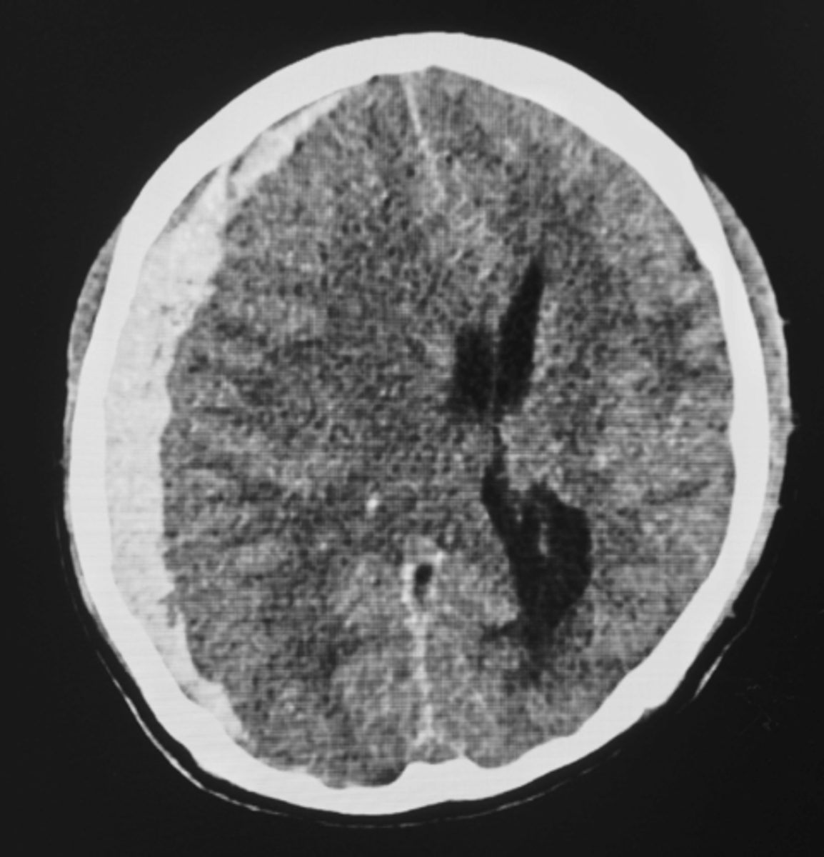 <p>- Between dura and arachnoid mater</p><p>- Tearing of bridging veins (alcohol use and older population)</p><p>- Acute or subacute neurological symptoms</p><p>- Neurosurgery consult, BP control, reverse anticoagulation</p>