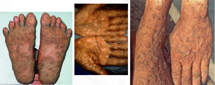 **Arsenic***:* 

* Hyperpigmentation and hyperkeratosis involving hands and feet
* Usually due to chronic inorganic arsenic poisoning
* Dermatologic lesions associated with chronic ingestion of arsenic in **drinking water**