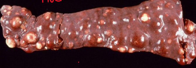 <p>What type of histiocytic sarcoma is this (+ ddx)</p>