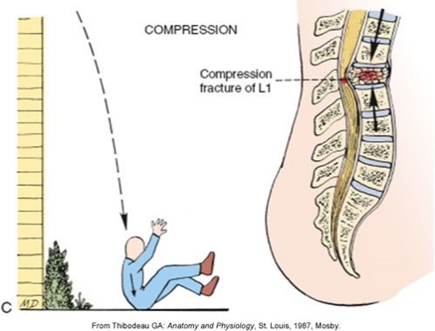 <p>Major Mechanisms of SCI:</p><p>- crush the vertebrae and force bony fragments into the spinal canal</p>