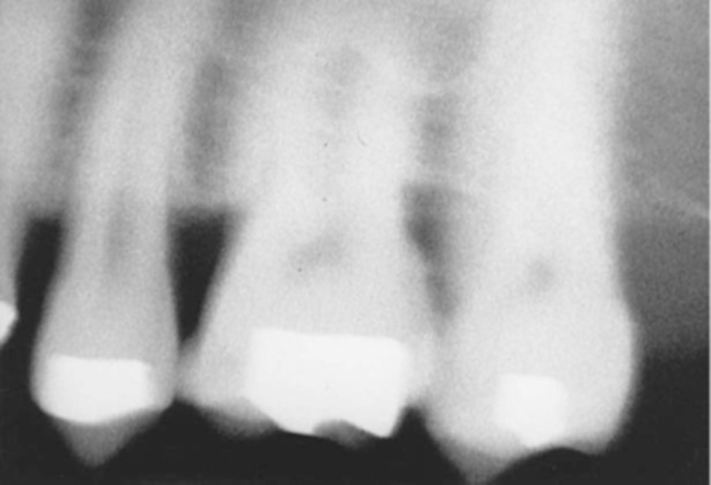 <p>-Blurred images are seen</p><p>-Either the tubehead or the patient moved during the exposure of the receptor</p>