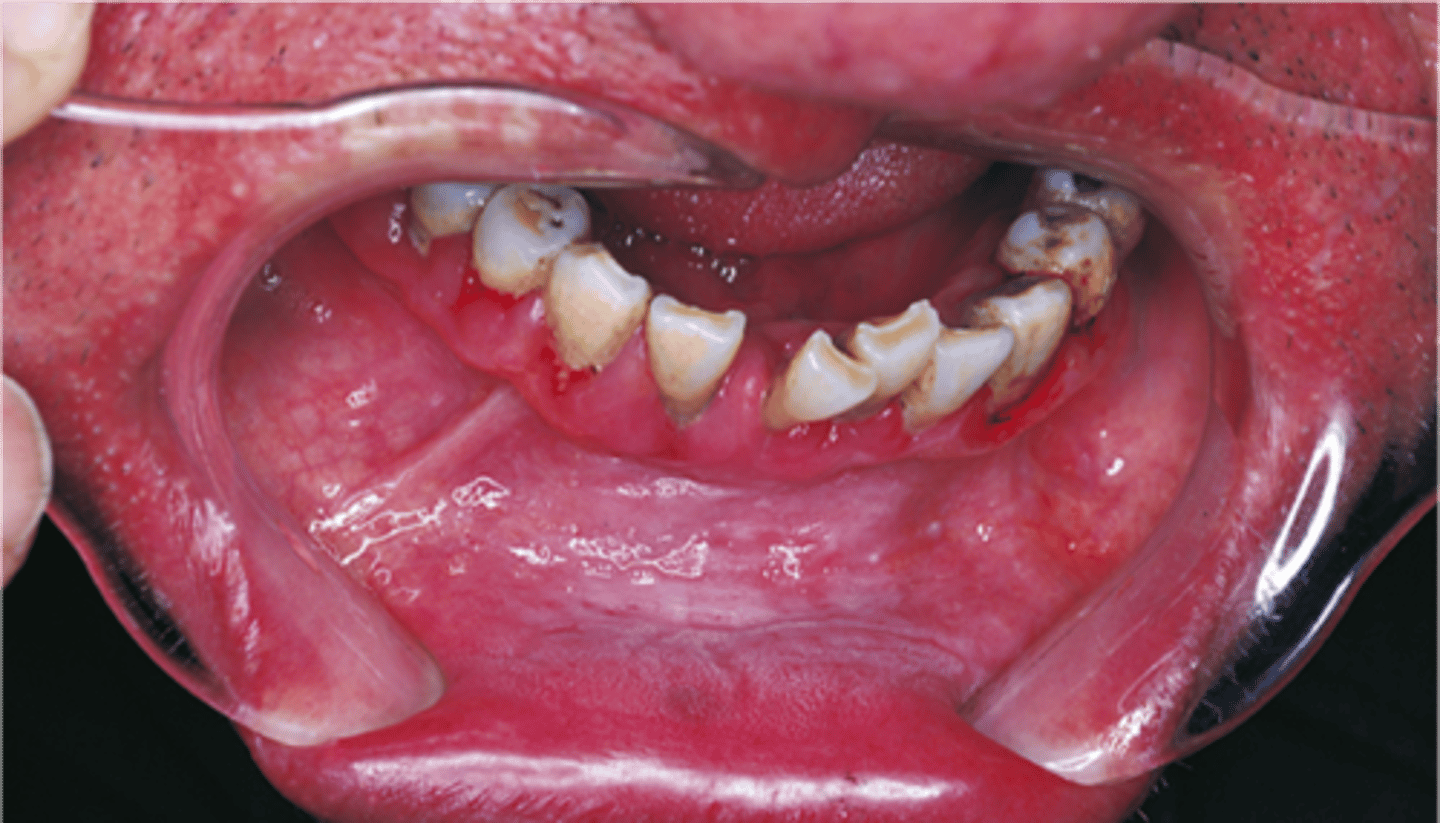 <p>Leukoplakia</p>