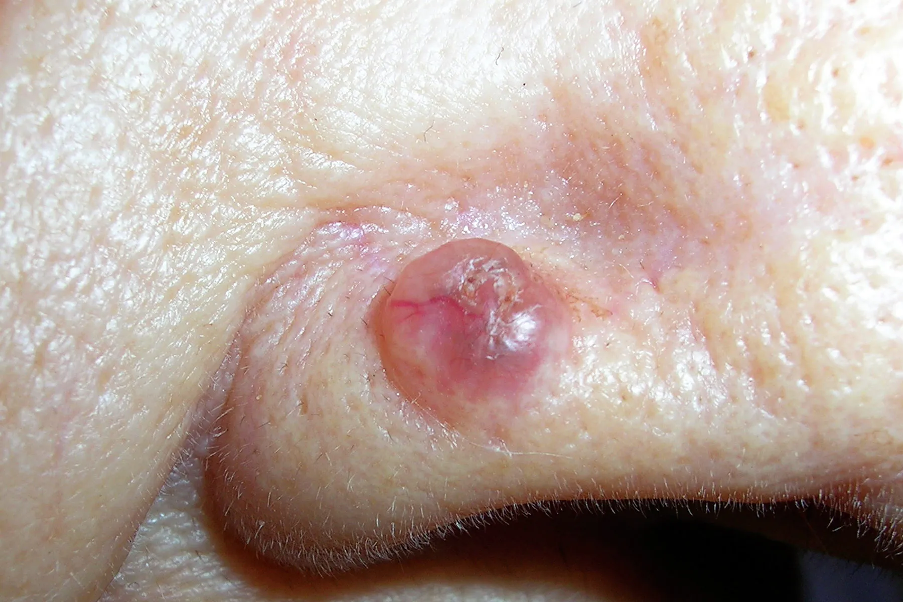 <p>Basal Cell Carcinoma</p>