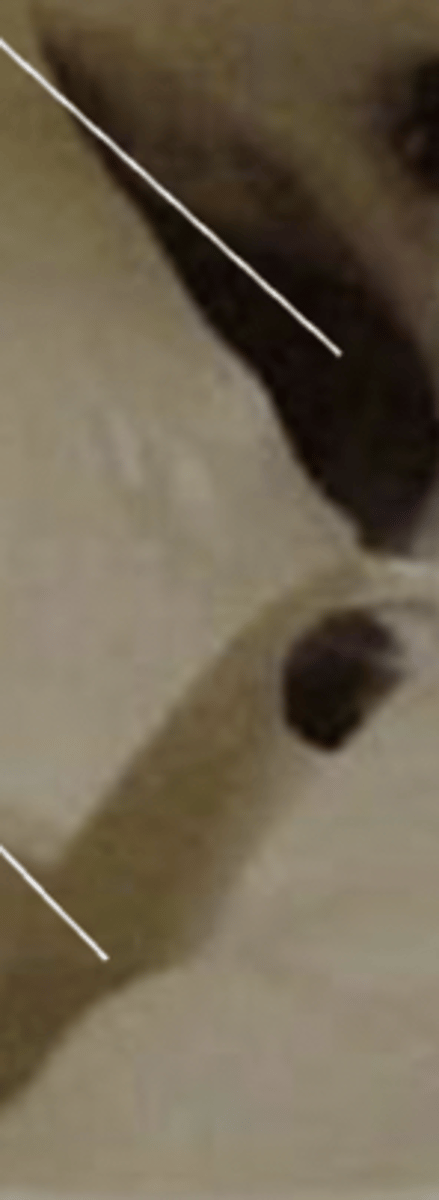 <p>top one is the superior orbital fissure of sphenoid and the bottom is the inferior orbital fissure of maxillary</p>