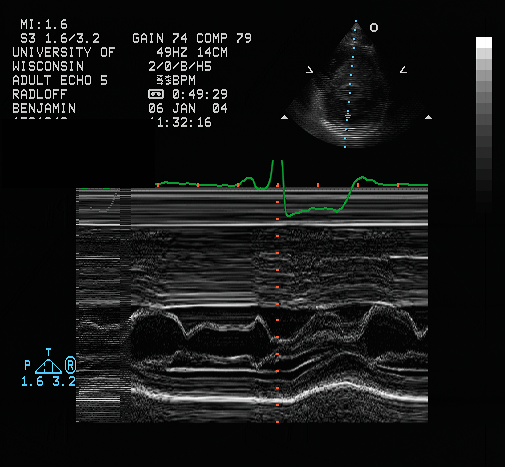<p>The M-Mode tracing above was done at the level of the mitral valve leaflets in the parasternal&nbsp;short&nbsp;axis on a patient that has&nbsp;documented hypertrophic cardiomyopathy.&nbsp; What critical finding does this M-Mode illustrate?</p><p></p><p>&nbsp;</p><p>aortic valve flutter</p><p>&nbsp;</p><p>increased A wave inflow</p><p>&nbsp;</p><p>systolic anterior mitral leaflet motion</p><p>&nbsp;</p><p>systolic posterior mitral leaflet motion</p>