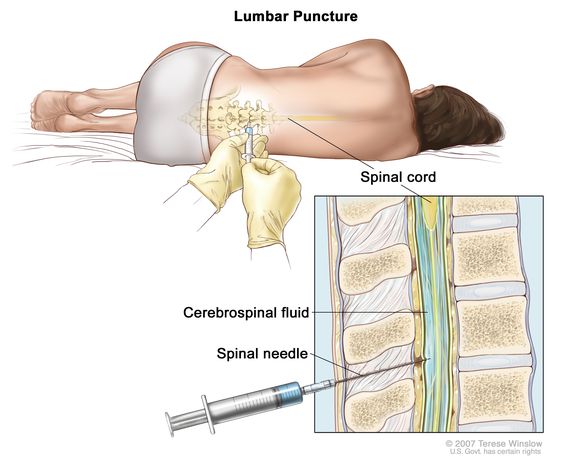 <ul><li><p>Needle passes through Skin, back muscles, ligamentum flavum</p></li><li><p>Lie on your side with your knees drawn up to your chest. Then a needle is inserted into your spinal canal — in your lower back — to collect cerebrospinal fluid for testing</p></li></ul>