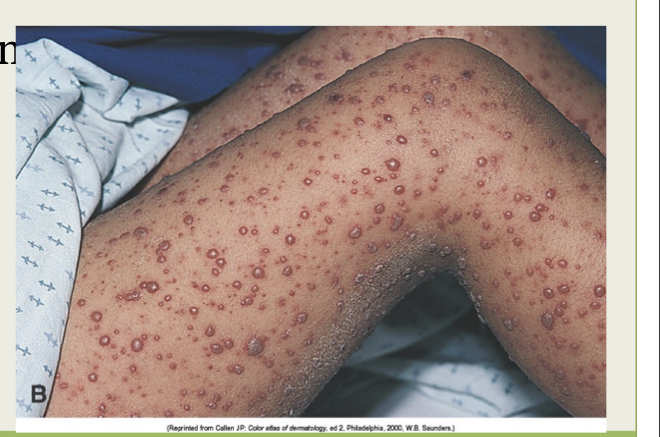 What infection is this?