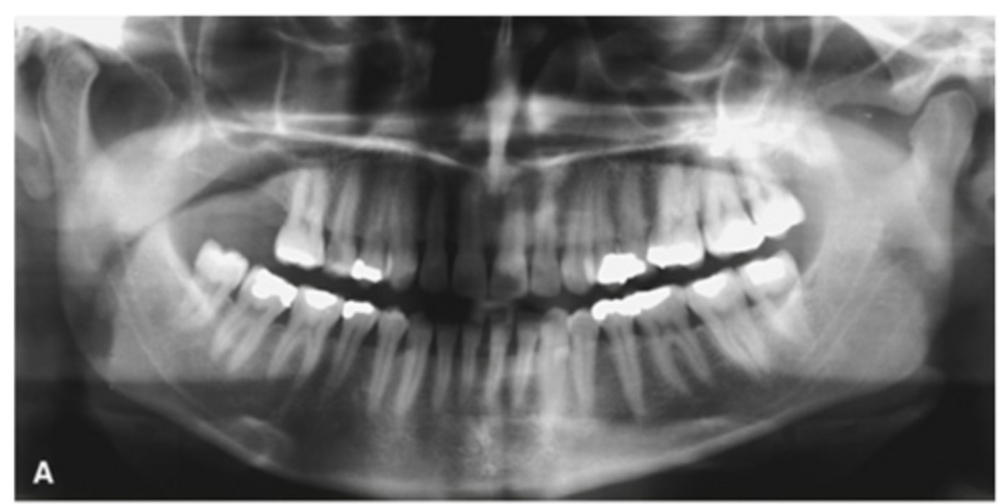 <p>Right condyle shows?</p>