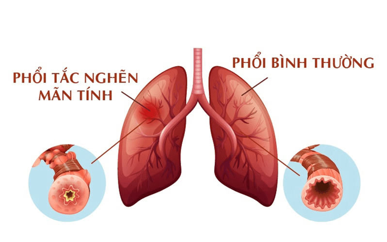 <p>bệnh phổi tắc nghẽn mãn tính</p>