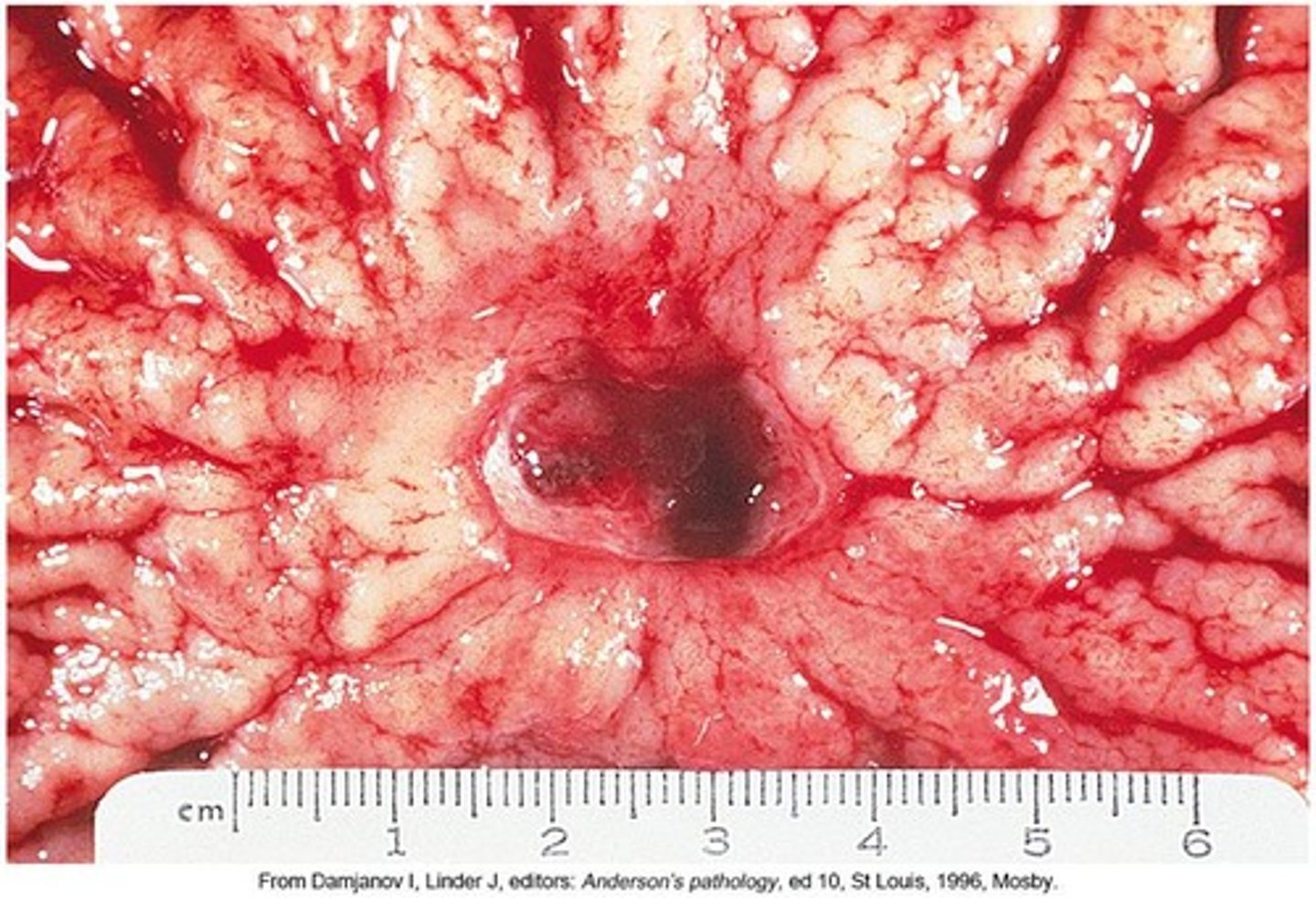 <p>Frank, bright red bleeding in emesis or dark, grainy digested blood (coffee grounds) in stool.</p>