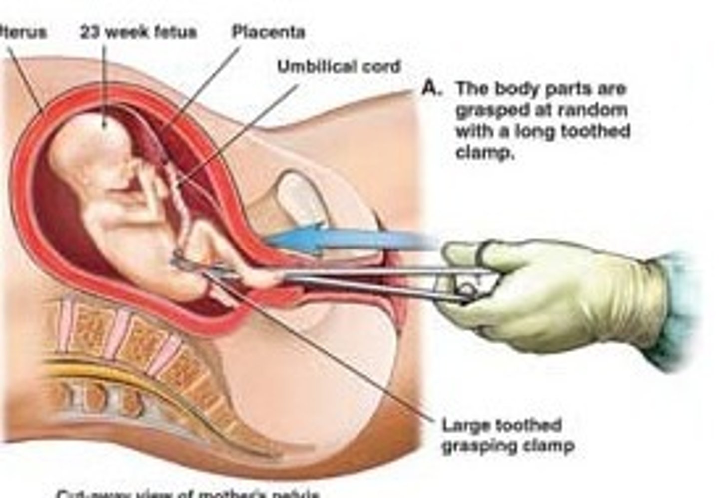 <p>to have a miscarriage, miscarriage</p>