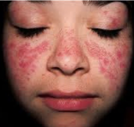 <p>Autoimmune disorder in which collagen in the  \n skin and connective tissues deteriorates; characterized by butterfly rash on nose and cheeks.</p>