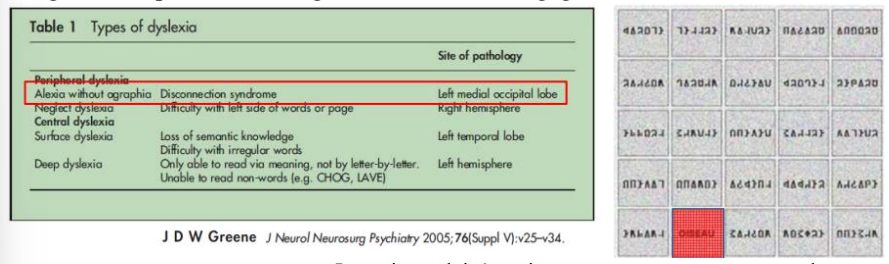 (agnosie associative) : déficit de la lecture de mots MAIS avec l’écriture conservée (alexie sans agraphie). La reconnaissance des lettres isolées est possible → Lecture littérale. Le mot devient une entité visuelle, plus rapide. Quand on apprend, on apprend lettre par lette, puis automatiquement, on commence à lire le mot globalement. Si le système est touché, le patient ne peut plus faire de lecture globale MAIS la lecture lettre par lettre est possible.
Lire sa propre écriture est devenu également impossible. Il s’agit d’une spécialisation à gauche, comme le langage.
Le vrai mot doit être vite reconnu par rapport aux pseudo-mots ; si ce n’est pas le cas, il y a une alexie pure.