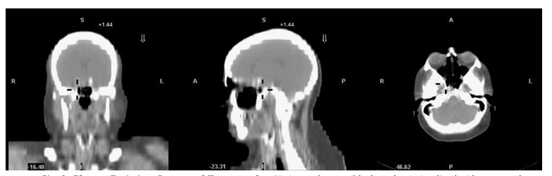 <p>It is similar to PET but involves the <strong><em>administration of radionuclides that emit gamma rays.</em></strong> It is less expensive than PET but provides more limited image resolution. It is commonly used to assess the coronary arteries, bone, brain, prostate, and thyroid.</p>