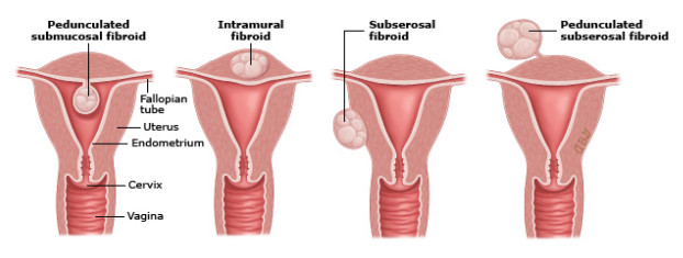 <p><strong>Uterine Fibroids: Background</strong></p><p>-Also known as uterine leiomyomas or myomas</p><p>-MC ______ pelvic neoplasm in females</p><ul><li><p>More common in _____ females </p></li></ul><p>-Noncancerous monoclonal _______ arising from the smooth muscle cells and ____________ of the myometrium</p><p>-Risk Factors → nulliparity, ______ menarche (<10 years old), prenatal exposure to diethylstilbestrol (DES), and ________ use (especially beer)</p><p></p>