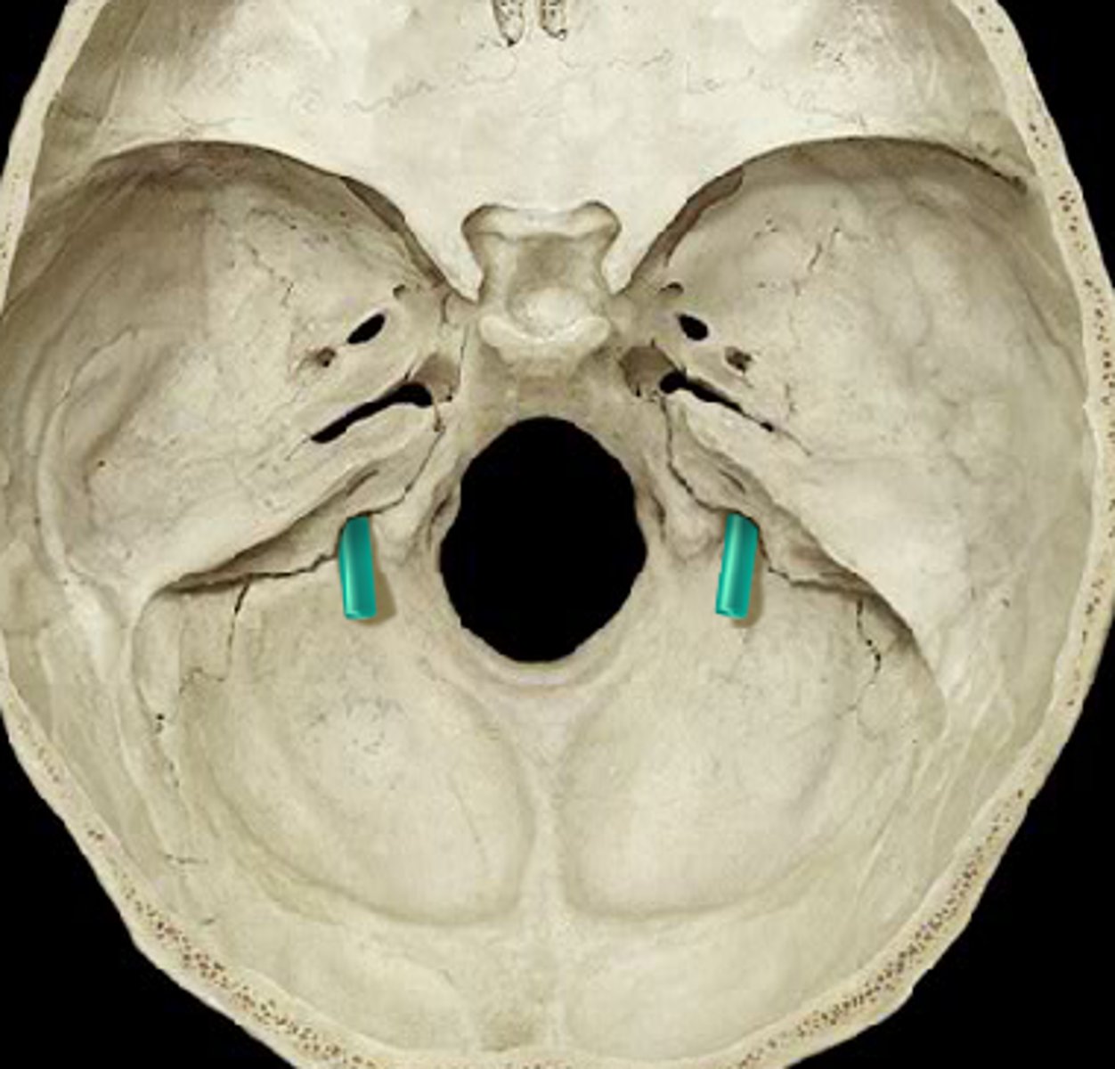 <p>Junction of Temporal and Occipital Bone</p>