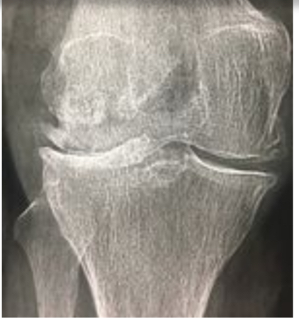 <ul><li><p>pincement de l’interligne FT externe </p></li><li><p>Ostéophytes externes </p></li></ul><p></p>