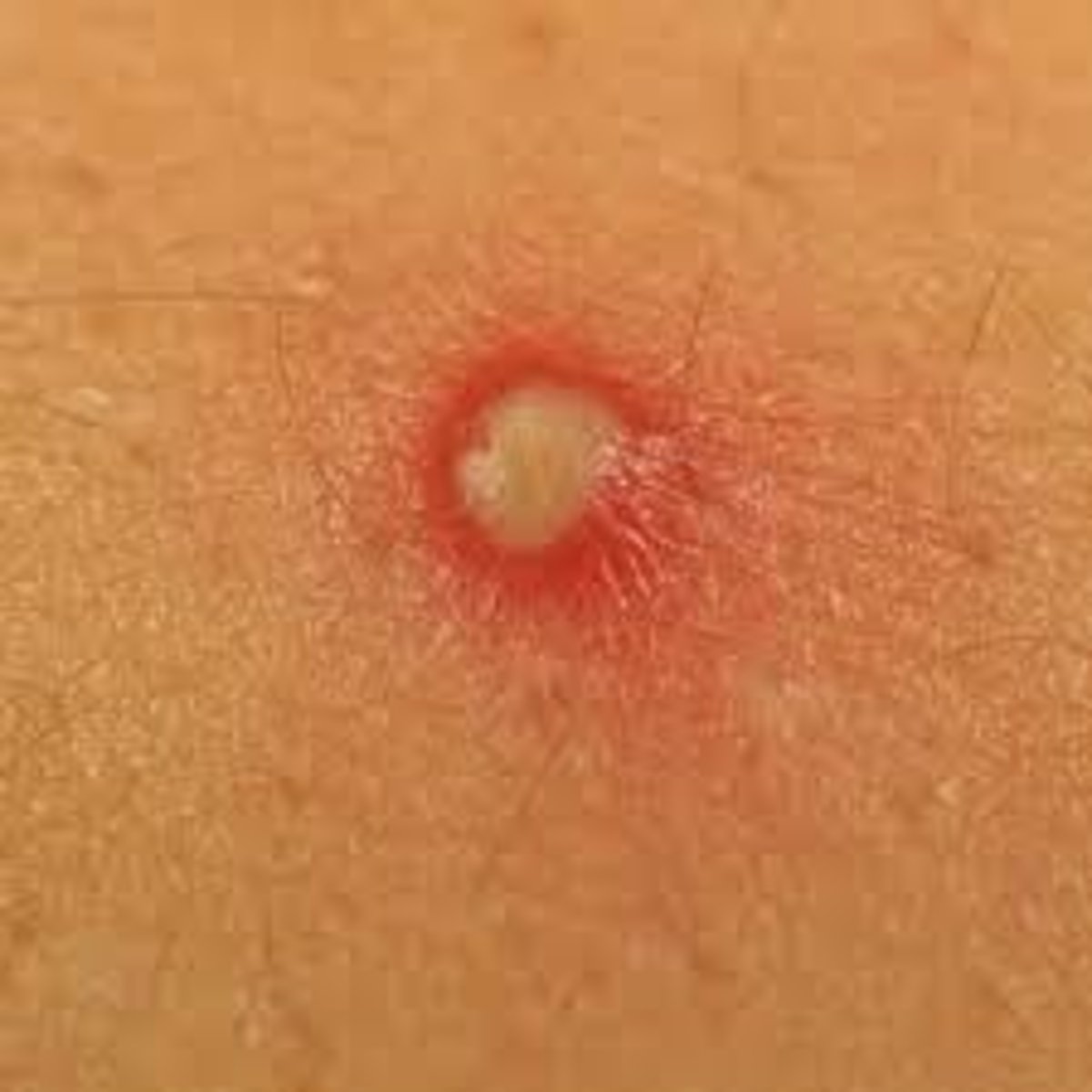<p>Pustule (THINK PUS)</p>