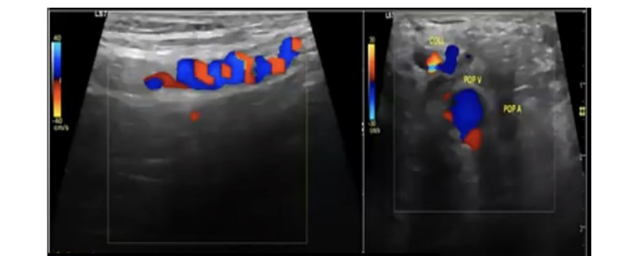<p>what is the preferred method to rule out Buerger disease in an upper extremity arterial exam? Evaluate the </p><p>.</p><p>a) shoulder arteries for extrinsinc compression w/movement</p><p>b) hands for vascular changes w/cold sensitivity testing</p><p>c) smaller arteries of arm w/duplex + PPG </p><p>d) arterial flow at rest + exercise </p><p>.</p><div data-youtube-video=""><iframe width="640" height="480" allowfullscreen="true" autoplay="false" disablekbcontrols="false" enableiframeapi="false" endtime="0" ivloadpolicy="0" loop="false" modestbranding="false" origin="" playlist="" rel="1" src="https://www.youtube.com/embed/UvkQ9zwmUBo?rel=1" start="0"></iframe></div><p></p>