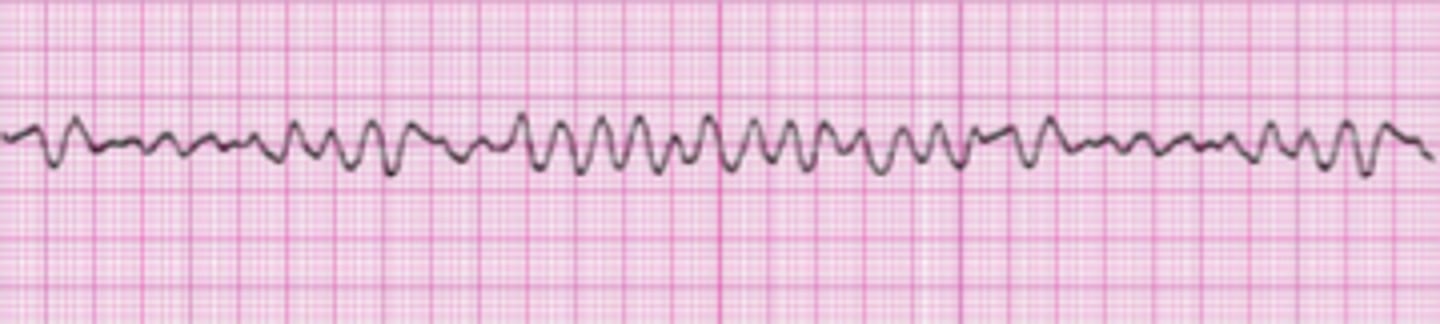 <p>- Chaotic electrical activity and cardiac activity</p><p>- Ventricles quiver</p><p>- There is no perfusion beat-producing rhythm</p><p>- The is no cardiac output or blood pressure.</p><p>- The patient will die in minutes without treatment – CODE</p><p>BLUE</p><p>- Treatment: Defibrillation and CPR until ROSC</p>