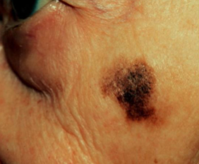 <p>blue/black CHANGING lesion with asymmetrical broders </p>