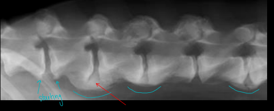 <p>Spondylosis Deformans</p>