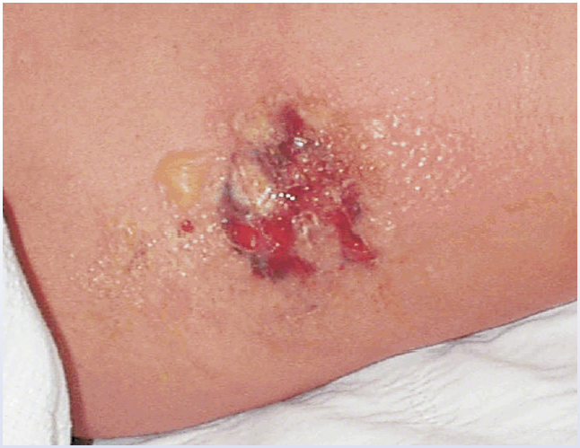 <p>2-days of red, severly painful lesion on forearm. felt a sting when putting the shirt on </p>