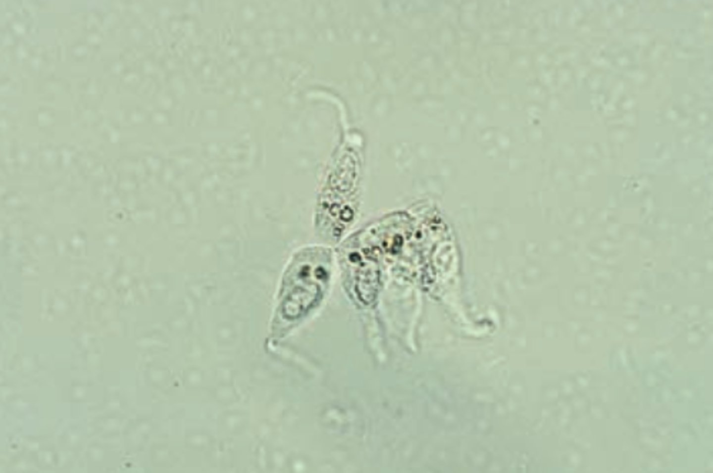 <p>-originate from the renal pelvis</p><p>- seen in patients with pyelonephritis or calculi in the renal pelvis</p>
