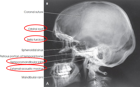<ul><li><p>entire cranium without rotation or tilt</p></li><li><p>superimposed orbital roofs and greater wings of sphenoid</p></li><li><p>superimposed mastoid regions, EAMs, and TMJs</p></li><li><p>sella turcica in profile</p></li><li><p>penetration of parietal region</p></li><li><p>no overlap of c-spine by mandible</p></li></ul><p></p>