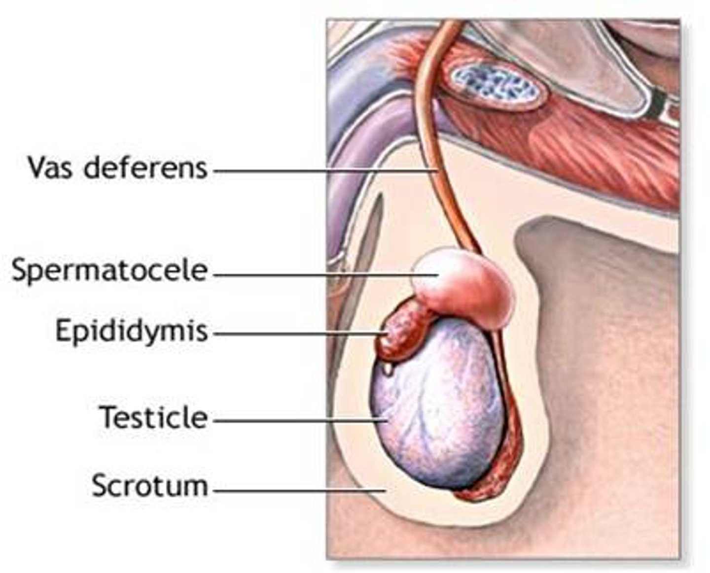 <p>distention of the epididymis containing an abnormal cyst-like collection of fluid and sperm cells; may cause scrotal swelling.</p>