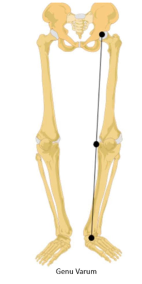 <p>"bowlegged" ; femoral shaft is more vertical and results in a low Q angle (5 degrees)</p><p>medial condyles take increased load</p>