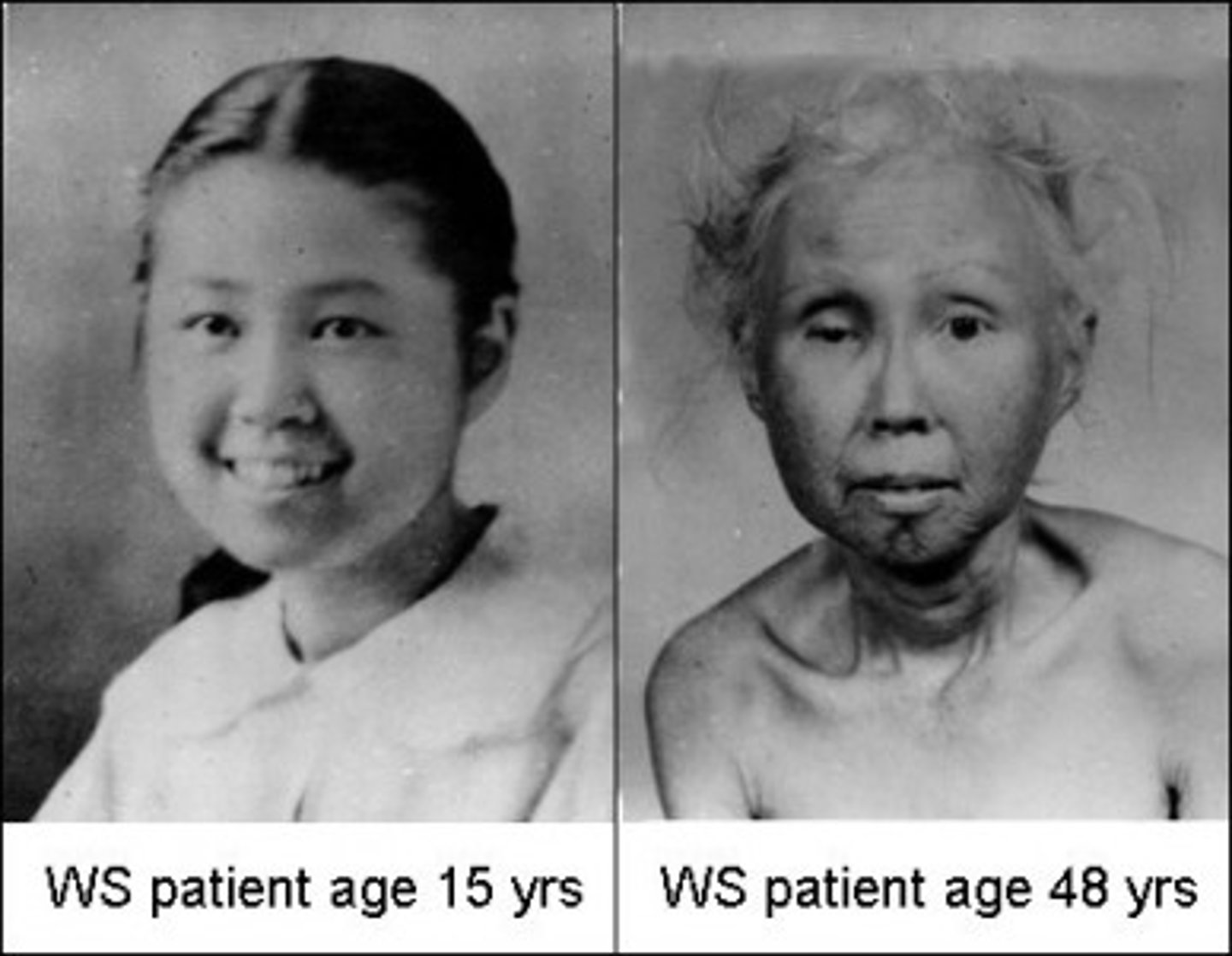 <p>this syndrome causes premature aging, variants of gene influence life span</p>