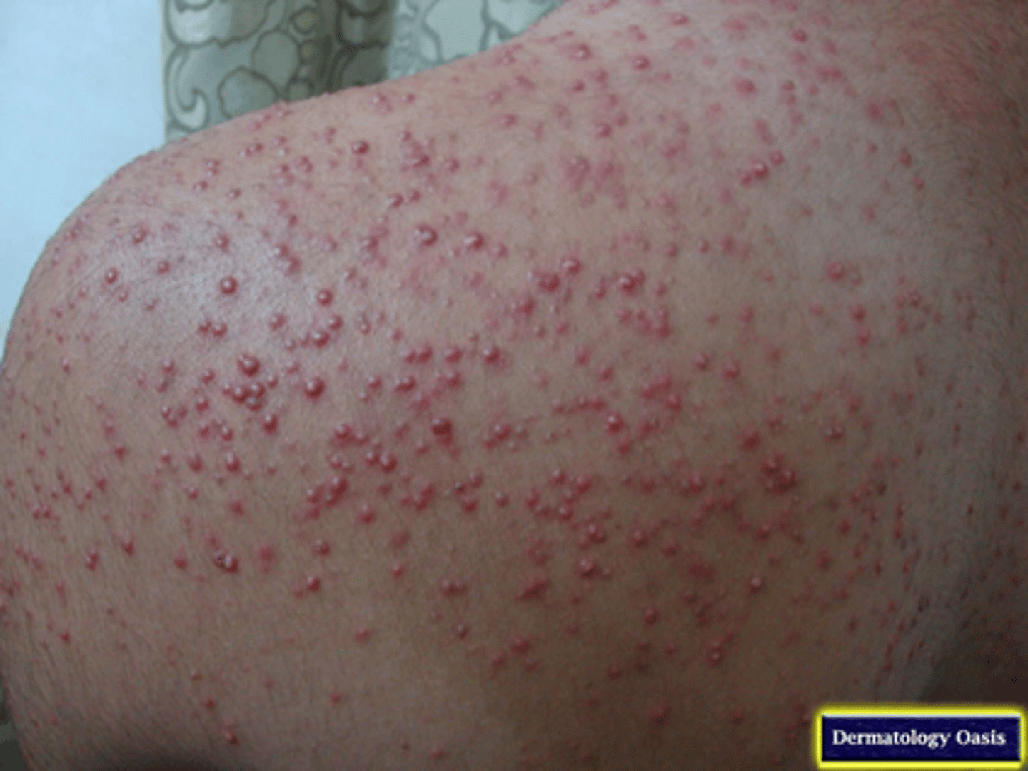 <p>pustular eruptions that appear in 1-3 weeks</p>