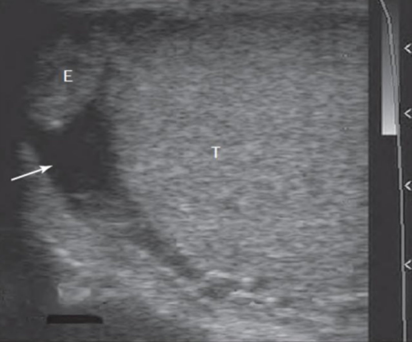 <p>A veterinarian is examining a stallion that presents with an enlarged scrotum. Ultrasonography of the scrotum reveals the findings shown in the picture. What is the most likely diagnosis?</p>