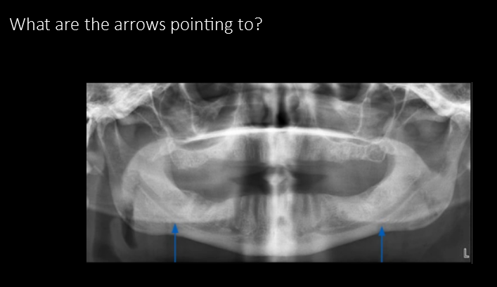 <p>Ghost image of mandible</p>