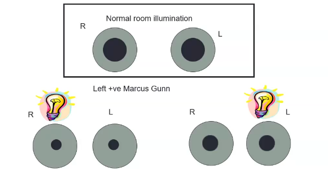 <p>afferet pupil defect- relative</p>