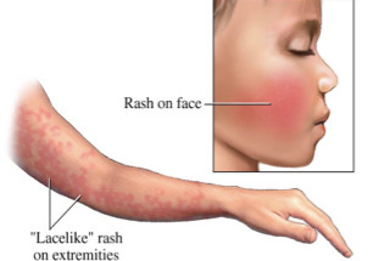 <p>Human parvovirus B19</p><p>Mild flulike symptoms; "slapped-cheek" facial rash</p>
