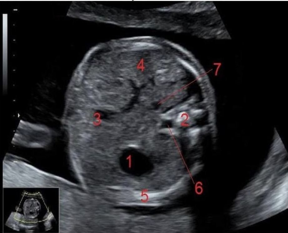 <p>what is #5</p><p>a) rib</p><p>b) right lung</p><p>c) left lung</p><p>d) diaphragm </p>