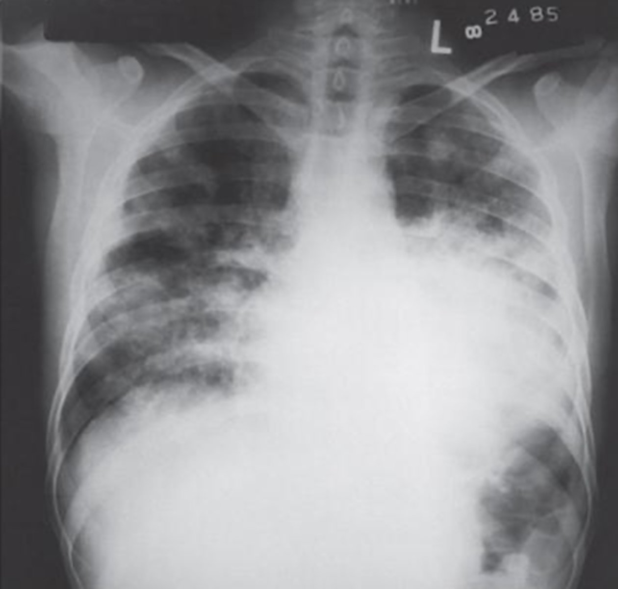 <p>What is the pathology in this image?</p>