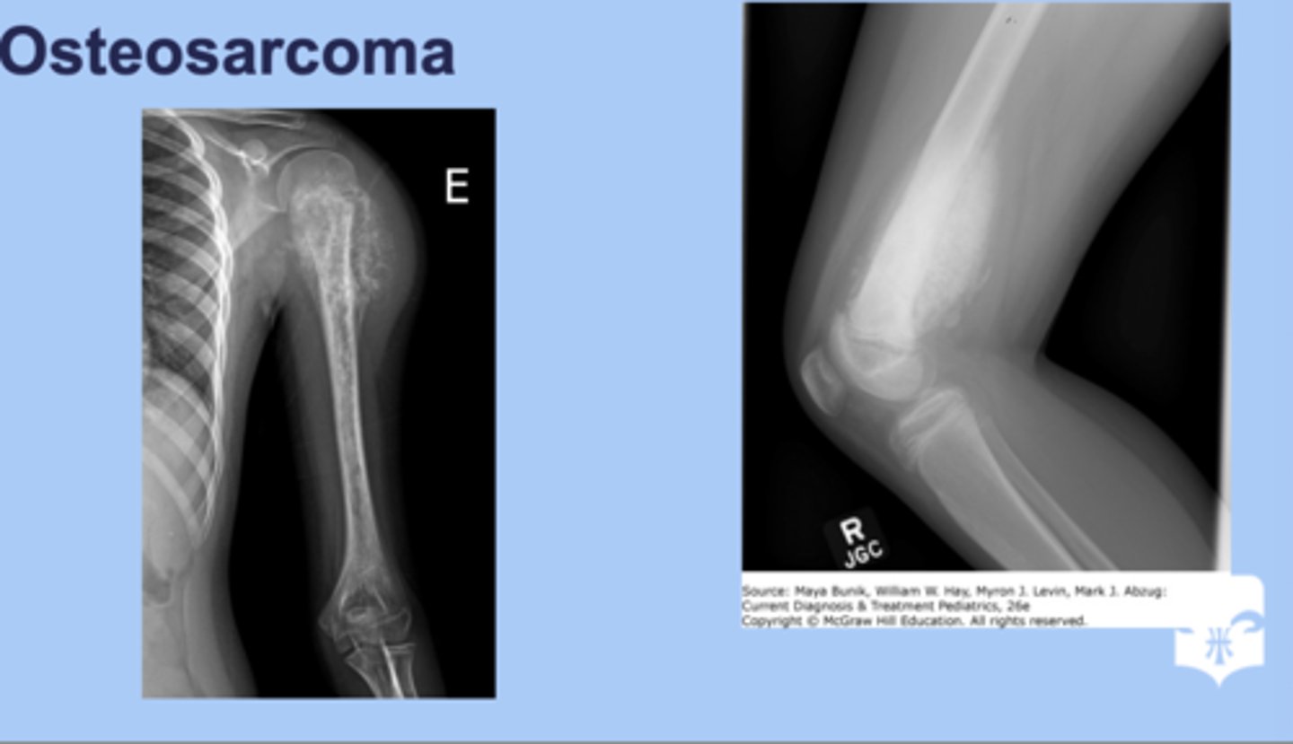 <p>-aggressive form of cancer</p><p>-femur, tibia, humerus, other long bones usually affected </p><p>-sx: pain in the long bone</p><p>-dx: Xray= sunburnt appearance </p><p>-tx: surgery, chemo and rediation</p>
