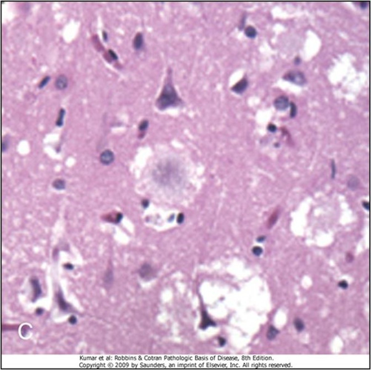 <p>Define Condition:</p><p>-Prion Disease linked to BOVINE Spongiform Encephalopathy</p><p>-See KURU PLAQUES</p><p>-Initially affects young adults</p><p>-Behavioral changes predominate initially, slower neurologic progression</p>