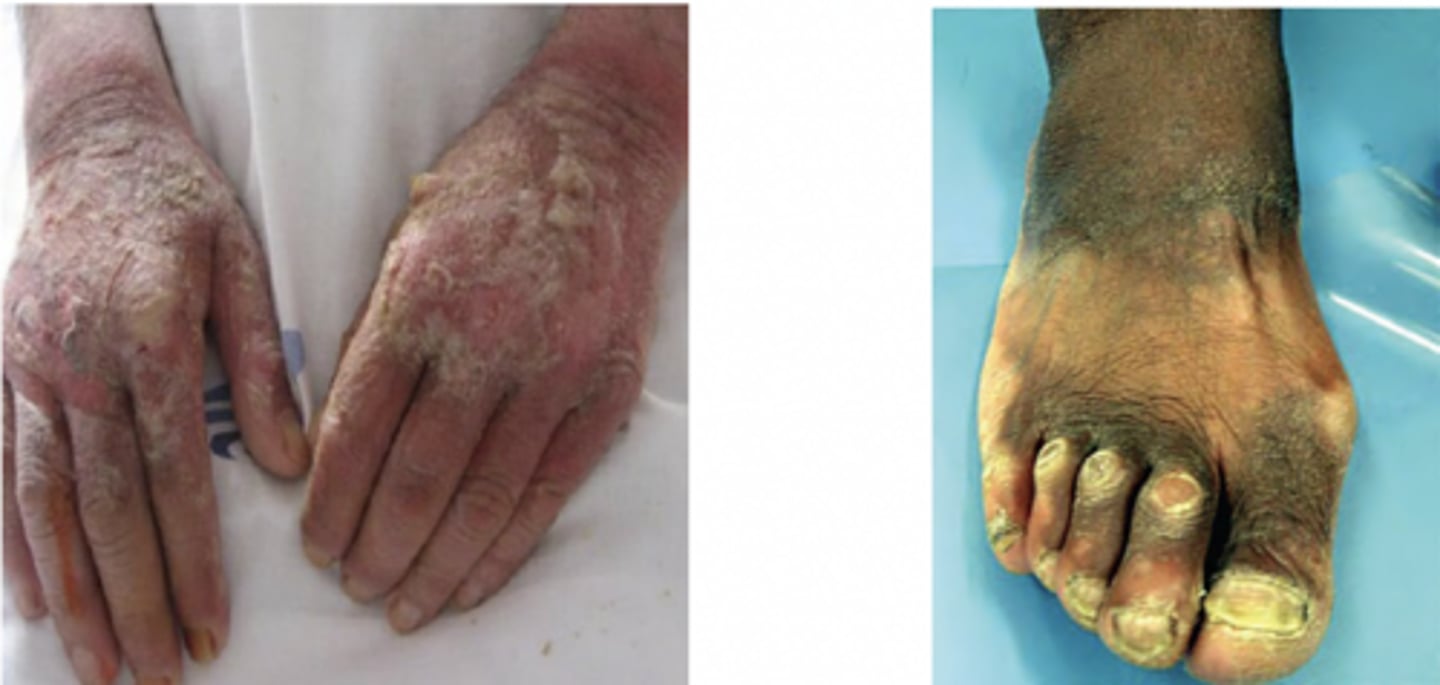 <p>3 D's for B3:</p><p>-dermatitis (symmetric on sun-exposed areas)</p><p>-dementia</p><p>-diarrhea</p>