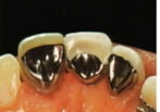 <p>Retention is developed by micro porosities present on the tissue surface of the retainer </p>
