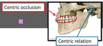 <ol><li><p>Centric relation → relationship between the upper jaw and lower jaw </p><ul><li><p>condyles of TMJ are in their most upward and backward position. </p></li></ul></li><li><p>Centric occlusion → relationship between the maxillary teeth and mandibular teeth </p></li></ol><p></p>