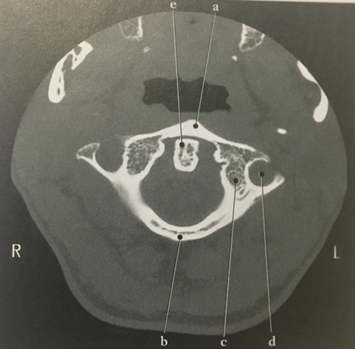 <p>Identify structure C on this axial CT slice of the C1.</p>