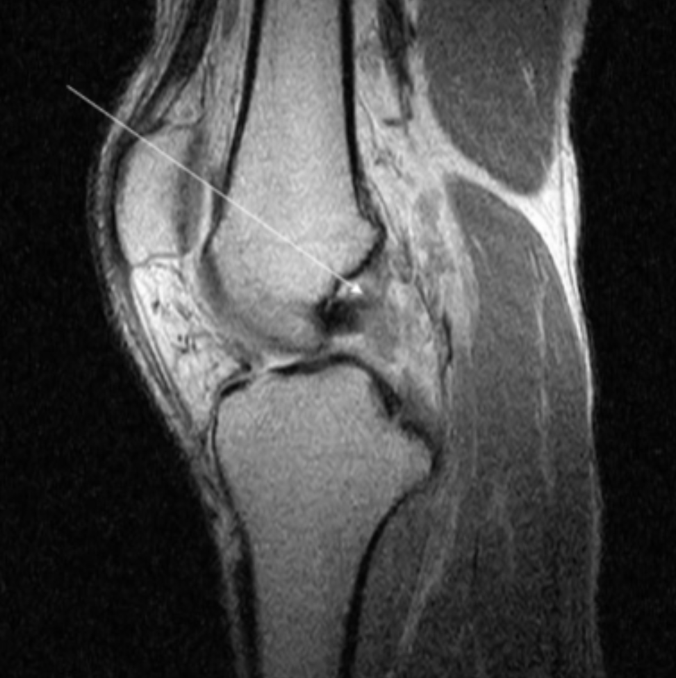 <p>Describe the pathology indicated by the arrow (Sag PD). </p>