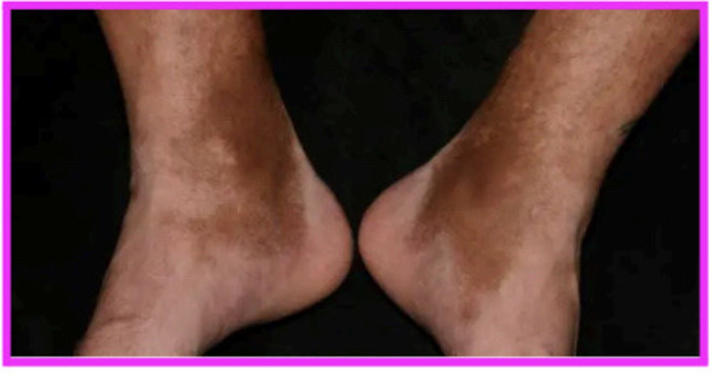 <p>venous insufficiency</p><p>-can lead to lymphedema</p><p>-needs to be treated!</p><p>-usually confined to the LEs (wounds on the medial aspect of the foot are commonly found)</p><p>-incompetent valves causing venous reflux</p><p>o clinical signs: edema, erythema, dermatitis, stasis pigmentation called hemosiderin (rusty reddish color from staining the skin due to RBC rusting)</p><p>venous insufficiency: results from weakened vein walls or valves, leading to blood pooling, edema, &amp; ulcers with irregular borders, often around the ankle</p><p>-swollen, warm to touch, hemosiderin (iron)</p><p>arterial insufficiency: involves poor blood flow due to blockages in the arteries, causing pain, pale skin, &amp; ulcers with defined borders</p><p>-diminished pulse, brittle nails, shiny skin</p><p>varicose veins: incompetent valves which produce increased venous pressure (leads to over stretched veins)</p><p>-tx: compression socks, exercise, procedures to close the veins</p><p>-s/s: edema, erythema, dermatitis, hemosiderin</p><p>-venous condition</p><p>chronic venous insufficiency treatment: edema reduction, preventing leg ulcerations, skin care, ambulation</p><p>-venous condition</p>