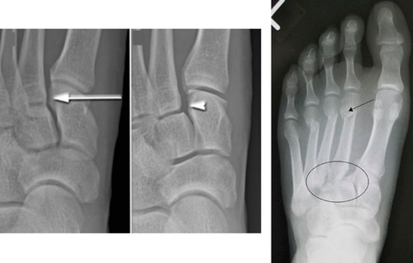 <p>lisfranc injury → tarsometatarsal (TMT) fx dislocation</p>
